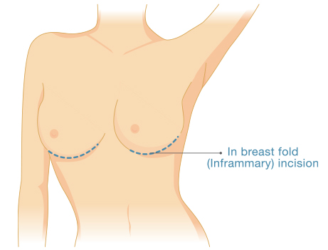 Breast Implant Incision Graphic